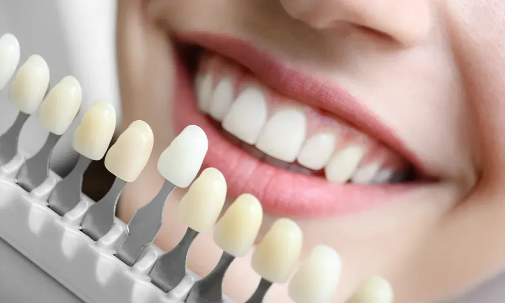 Here's an alt tag for the image: Teeth whitening shade guide and smile.