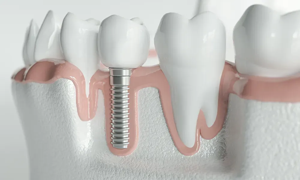 Dental implant with crown in jaw.