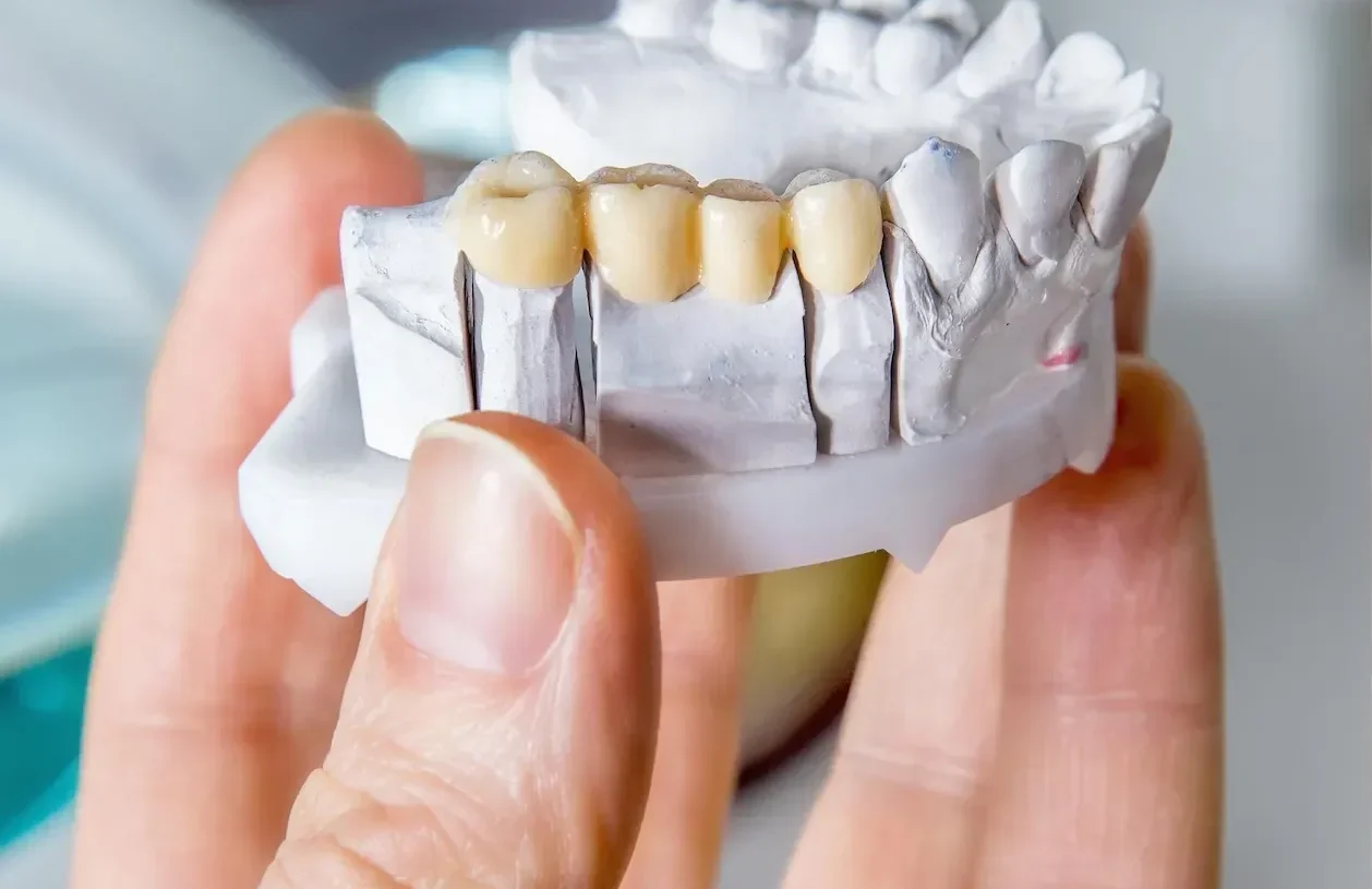 Dental model with four new crowns.