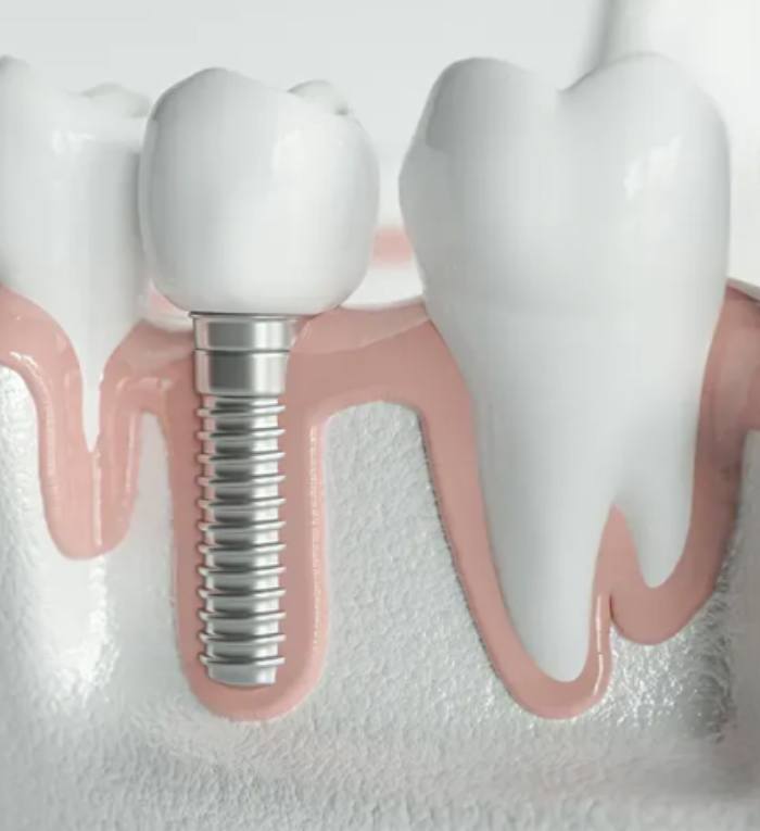 Dental Implants